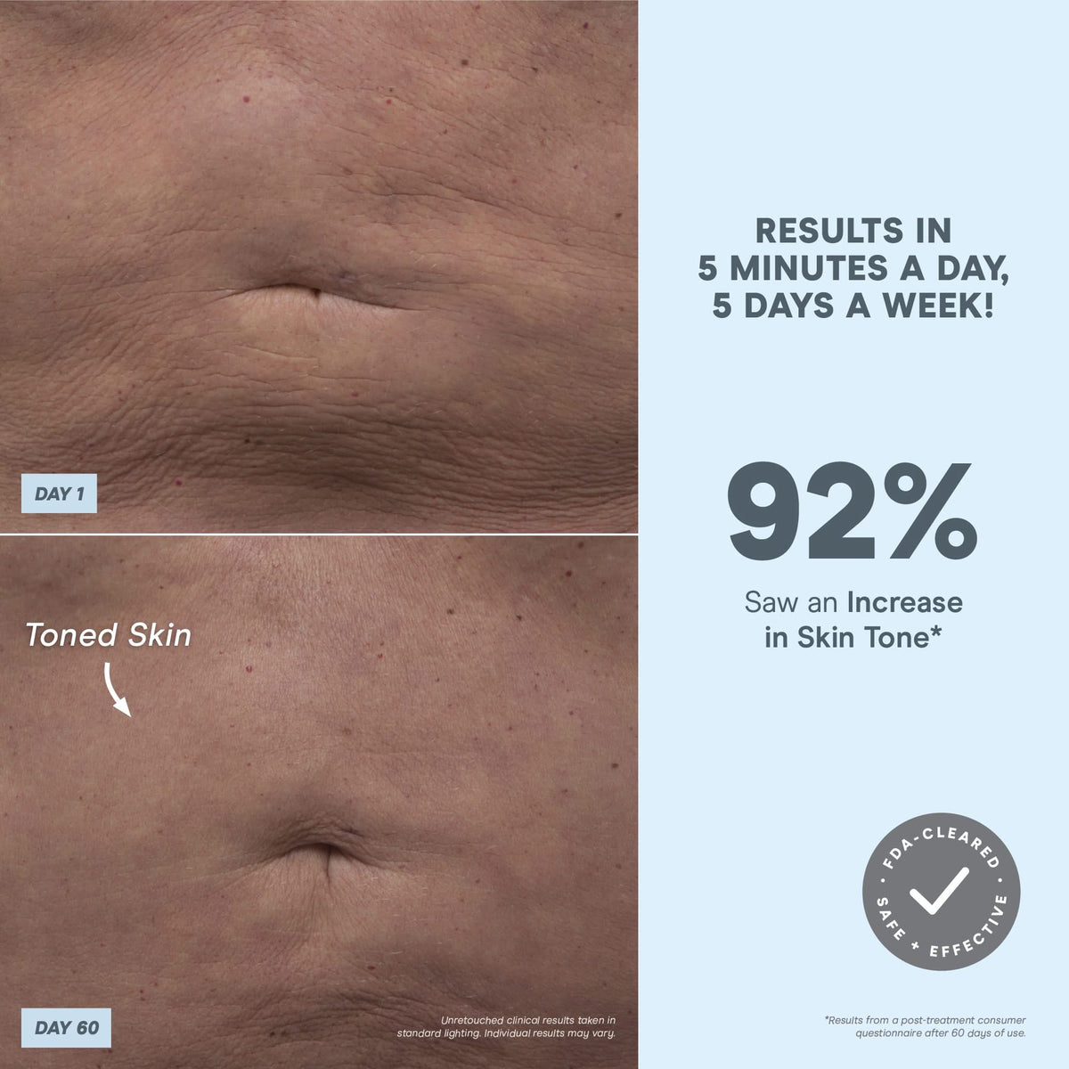 NuBODY® - Microcurrent Skin Toning Device for Body